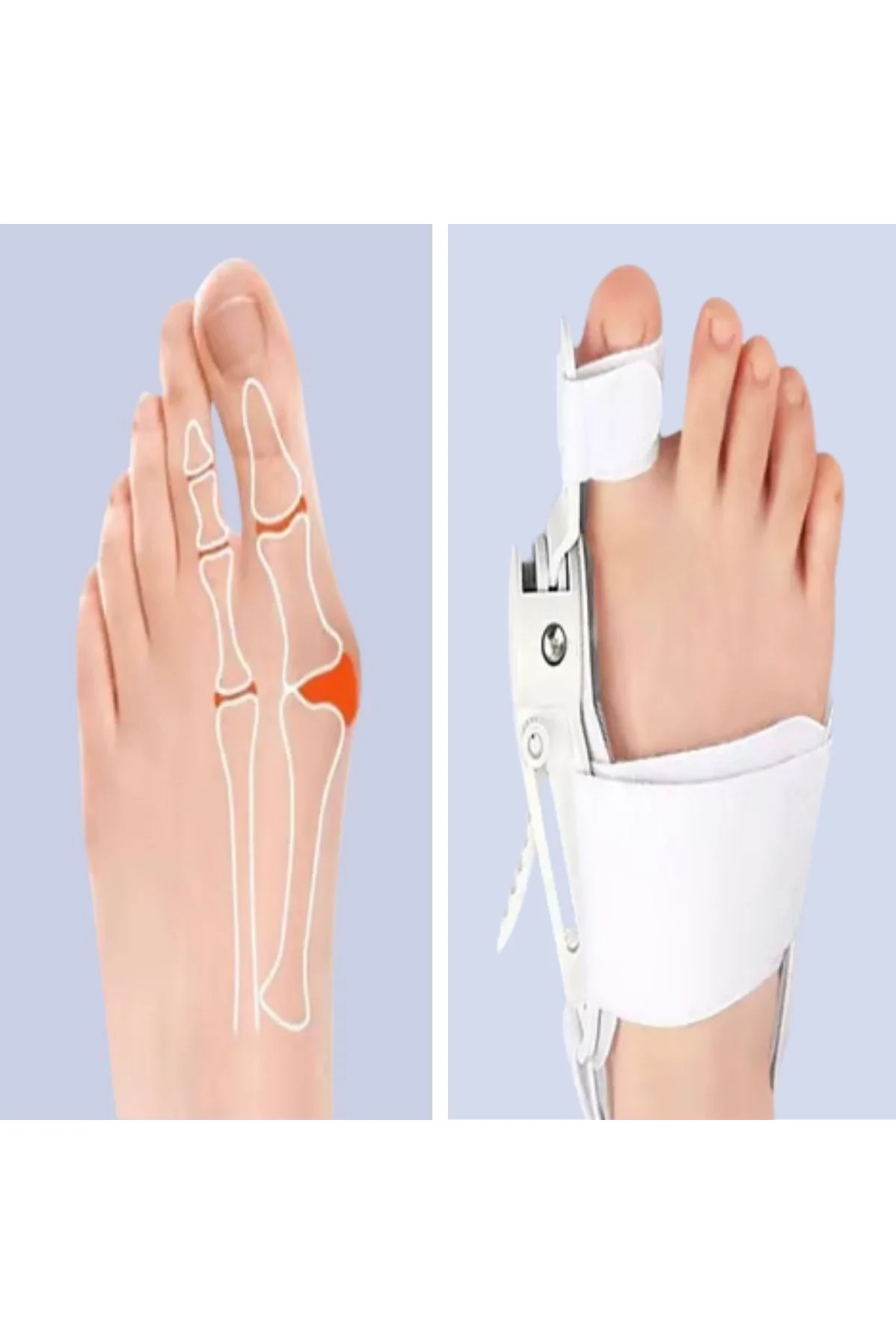 Ayarlanabilir Ayak Baş Parmak Kemik Düzeltici – Halluks Valgus (Bunyon) Aparatı, Gece Gündüz Kullanı - Just Cheap Store Görsel 3